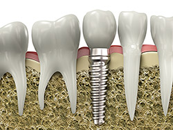 Dental Implant Model - Chambers Bridge Dental